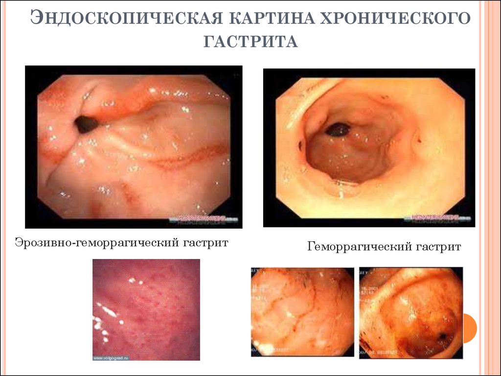 Хронический гастрит. Язвенная болезнь - online presentation