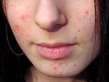 Причины и лечение в домашних условиях угревой сыпи на коже спины и лице