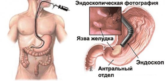 эндоскопическое исследование желудка