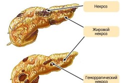 Виды панкреонекроза