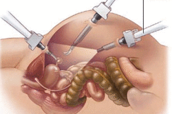 Лапароскопия кисты поджелудочной железы