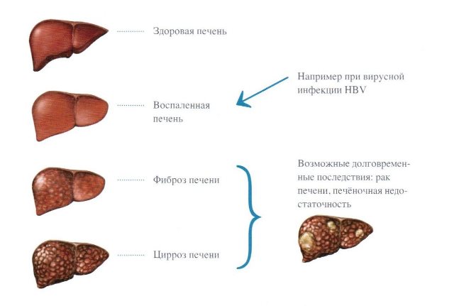 Последствия гепатита