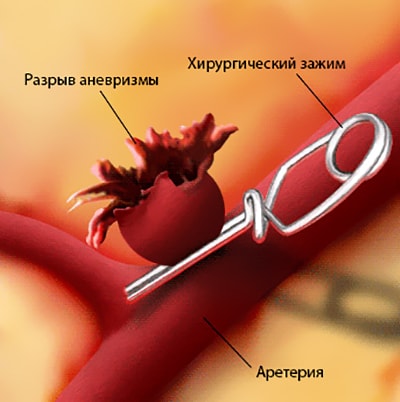 Хирургический зажим на артерии, способный отключить аневризму из процесса кровообращения