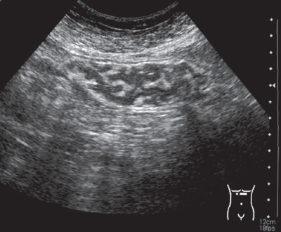 Ультразвуковое изображение складок слизистой оболочки желудка в норме