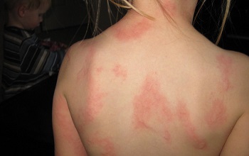 Аллергия от травы на коже рук