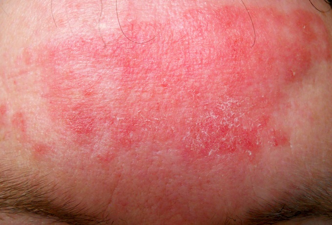 Аллергия от травы на коже рук