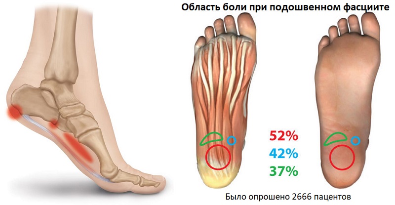 Статистика боли при подошвенном фасциите