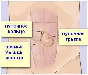 umbilical-hernia-surgery