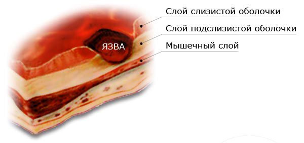 Язаенная болезнь 12-перстной кишки