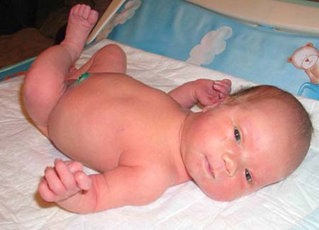 Норма билирубина у новорожденных при желтушке у новорожденных