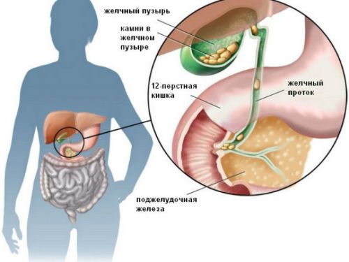 Камни желчного пузыря