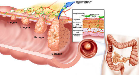 стадии формирования полипа в кишечнике