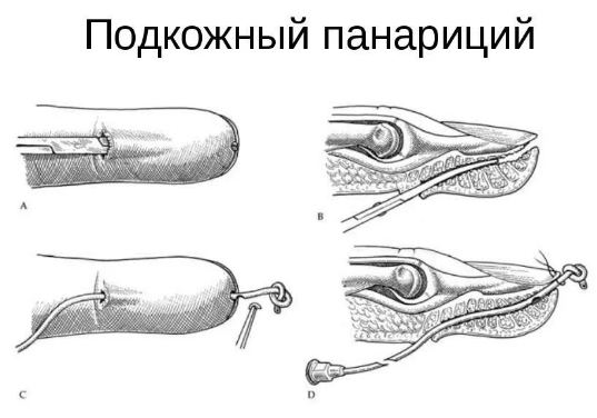 хирургическое лечение панариция