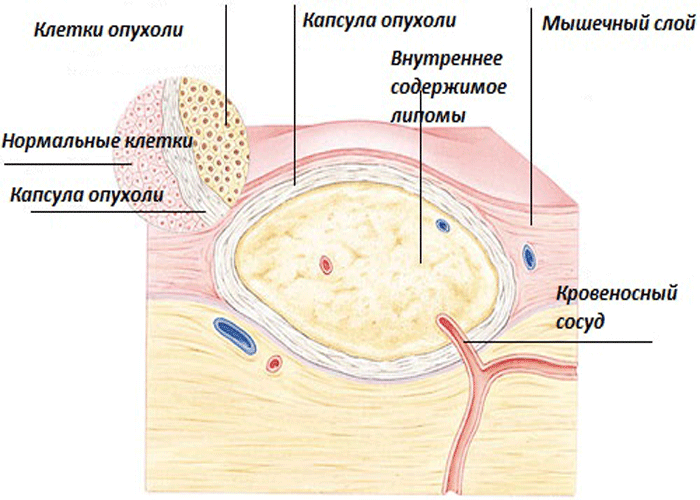 Схематическое изображение липомы