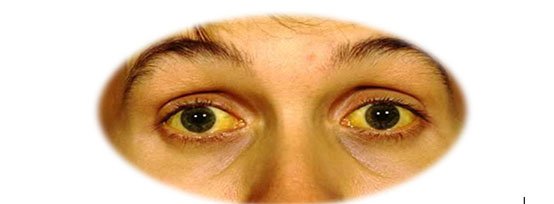 Желтые склеры глаз и желтизна кожи 