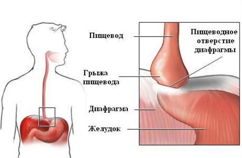 Грыжа пищевода