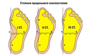 Как проверить наличие плоскостопия