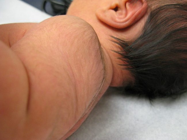 Волоски на теле новорождённого