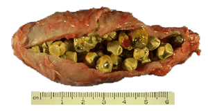 gallstones