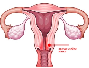 Можно ли и как вылечить эрозию шейки матки без прижигания?
