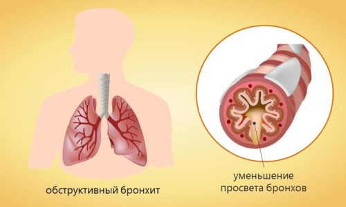 Хронический обструктивный бронхит сопровождается одышкой и влажным кашлем и является патологическим заболеванием в процессе которого страдают бронхи и легкие