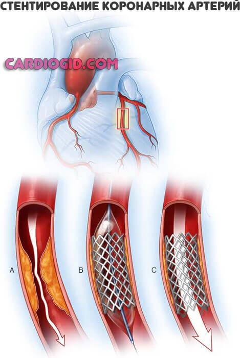 стентирование-коронарных-артерий