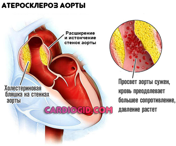 атеросклероз-аорты