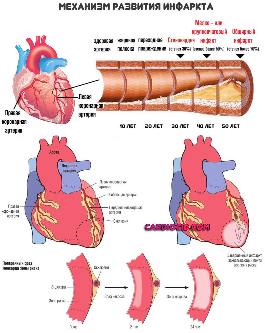 патогенез инфаркта