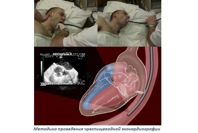 Эхо сердца что это. Чреспищеводная ЭХОКГ показания. Чреспищеводное УЗИ сердца. Чреспищеводная эхокардиография (ЧПЭХОКГ).