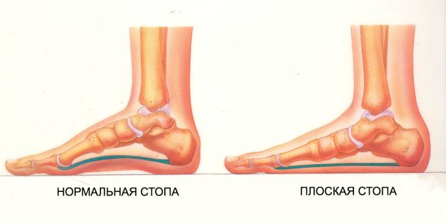 упражнения при плоскостопии: Нормальная и плоская стопы