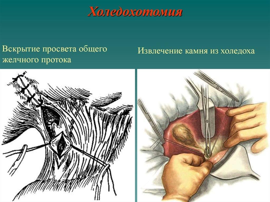 Операция на желчном пузыре