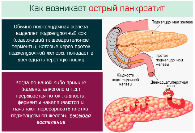 Острый панкреатит - как возникает 