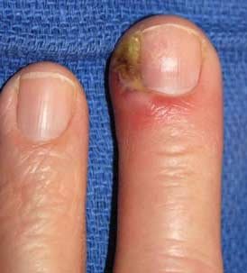 Причины, симптомы и лечение шишки на ноге возле большого пальца