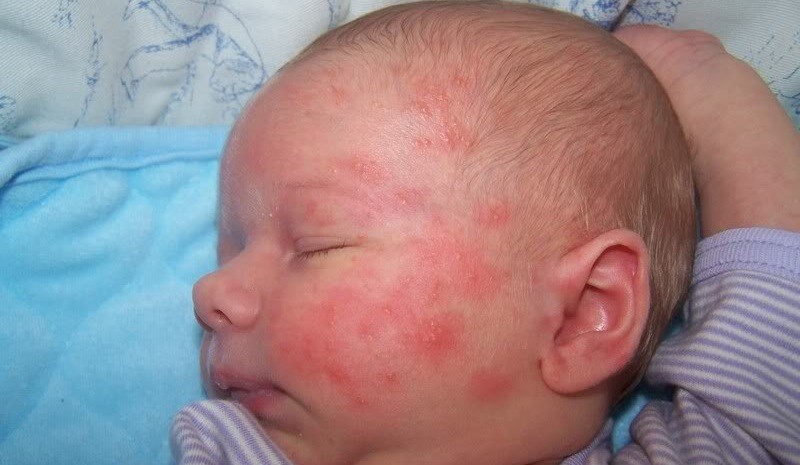 Пищевая аллергия у ребёнка, фото