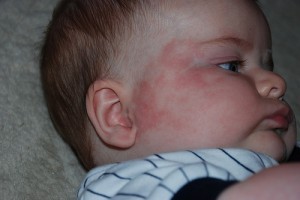 Пищевая аллергия у ребёнка, фото