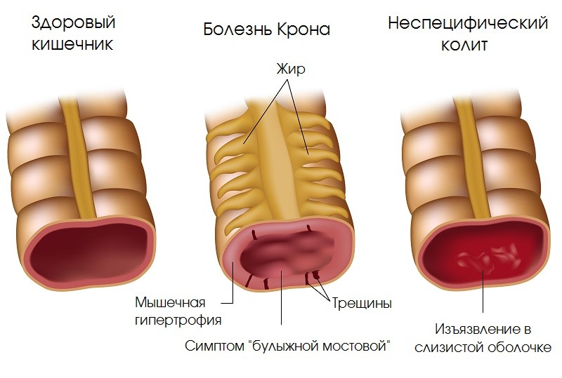 Болезнь Крона