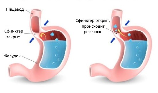 Рефлюкс-эзофагит