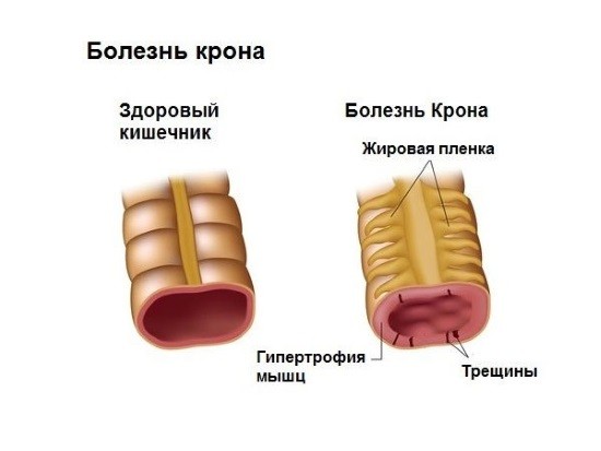 Гранулематозный энтерит