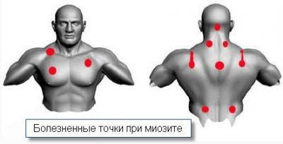 Болезненность при миозите