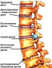 Патологии позвоночника