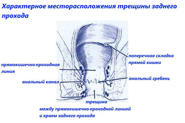 Характерное месторасположения трещины заднего прохода