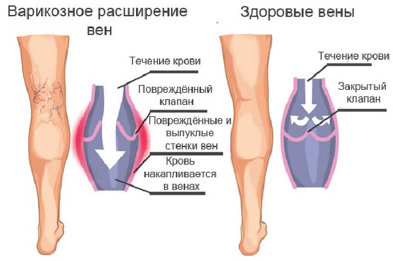 Замучал варикоз