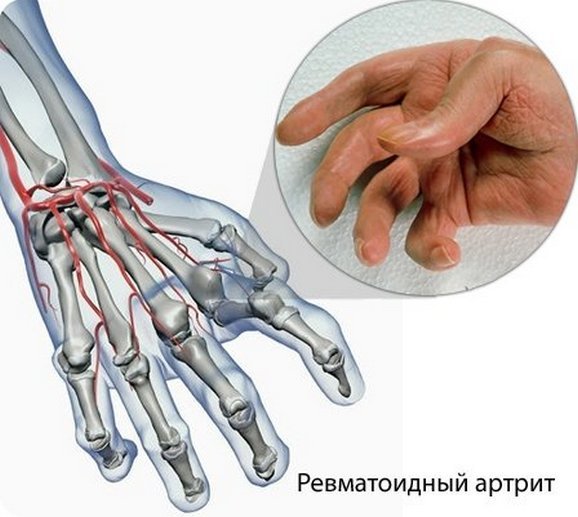 Ревматоидный артрит пальцев рук: 6 первых симптомов 
