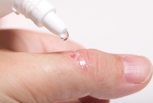 Как обрабатывать рану перекисью водорода?