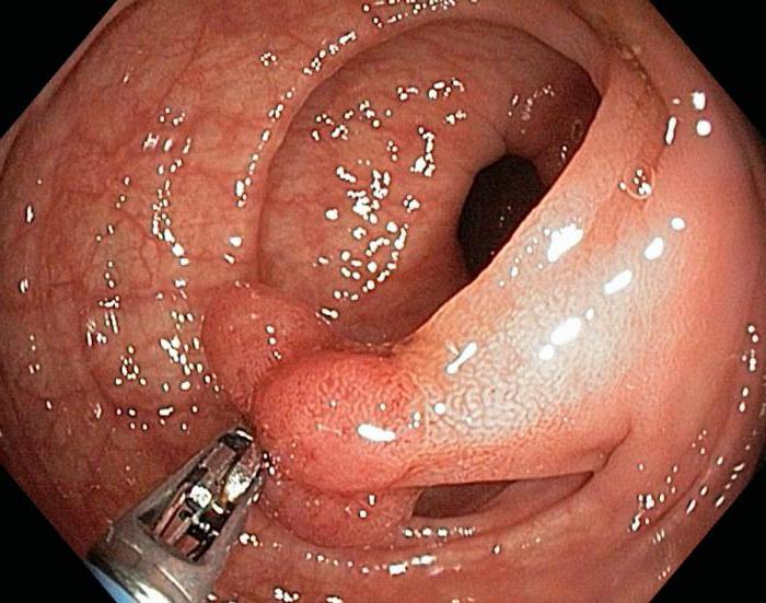 тубулярная аденома кишки