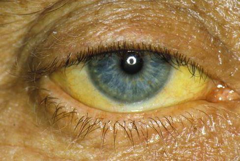 желтые глаза у человека симптомы