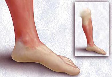 рожистое воспаление ноги лечение народными средствами