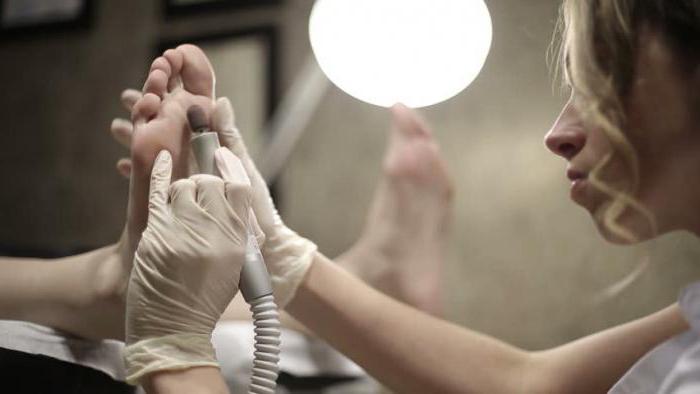 стержневая мозоль между пальцами ног лечение 