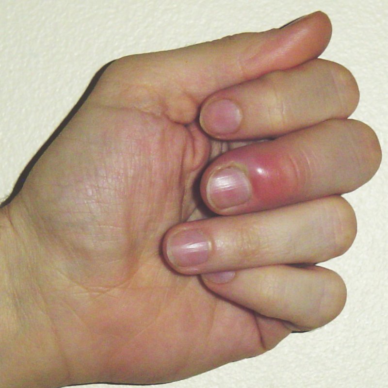 панариций пальца на руке лечение