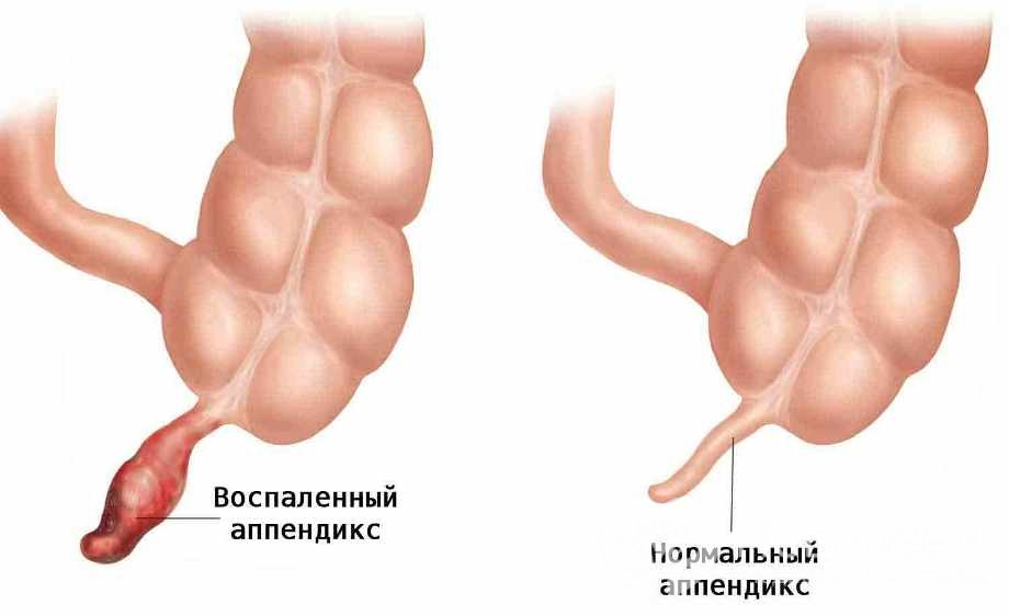 аппендицит мкб 10